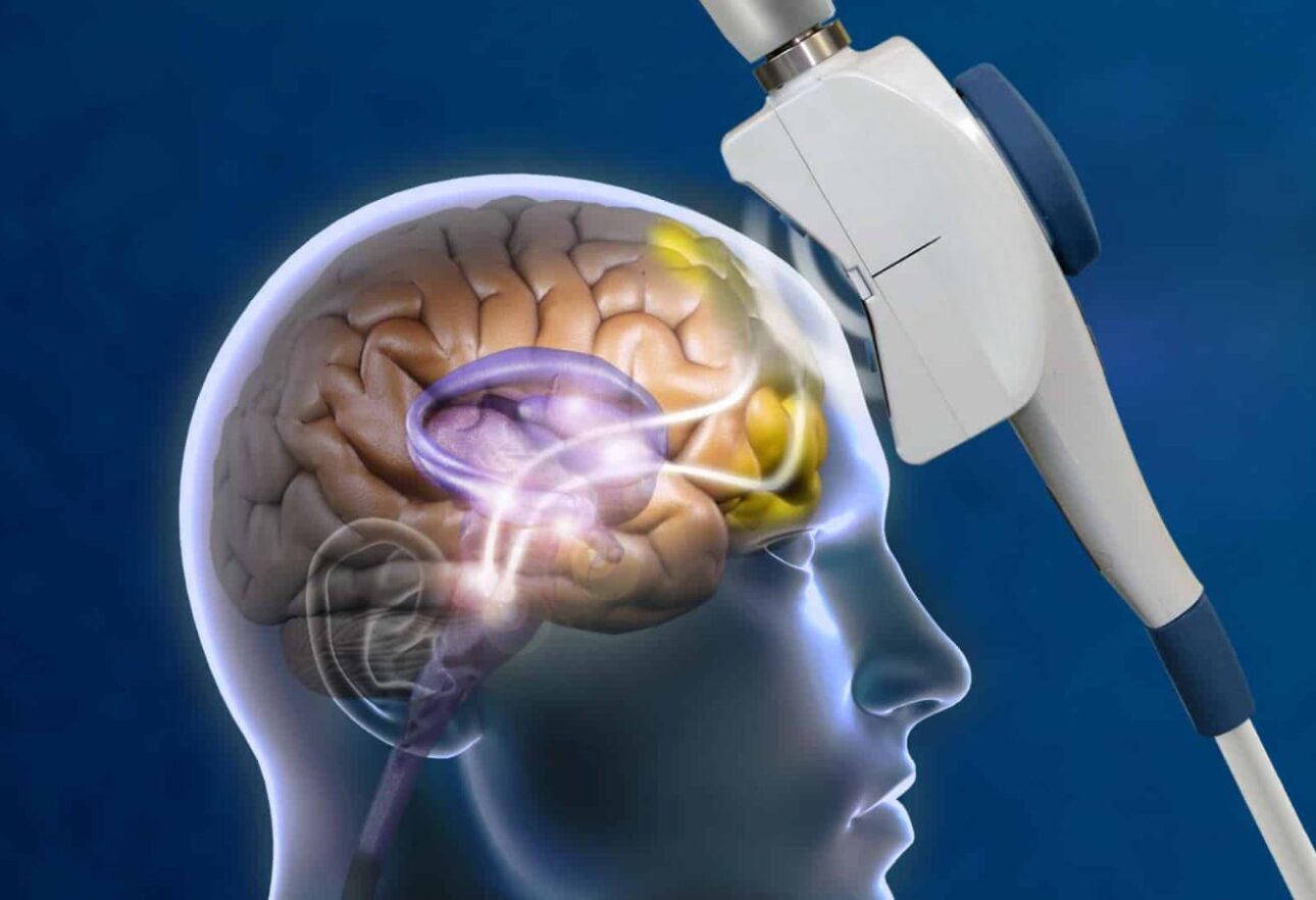 what is tms transcranial magnetic stimulation therapy for depression anxiety
