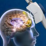 what is tms transcranial magnetic stimulation therapy for depression anxiety