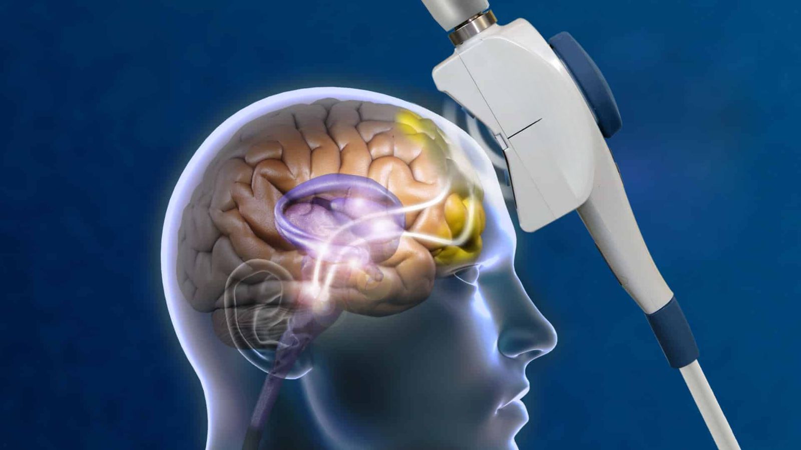 what is tms transcranial magnetic stimulation therapy for depression anxiety